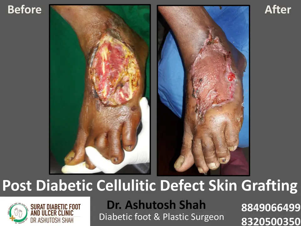 Diabetic Foot  PPT 3 checked by sir.pptx-58.webp